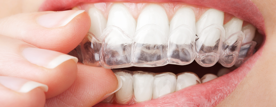 teeth with whitening tray