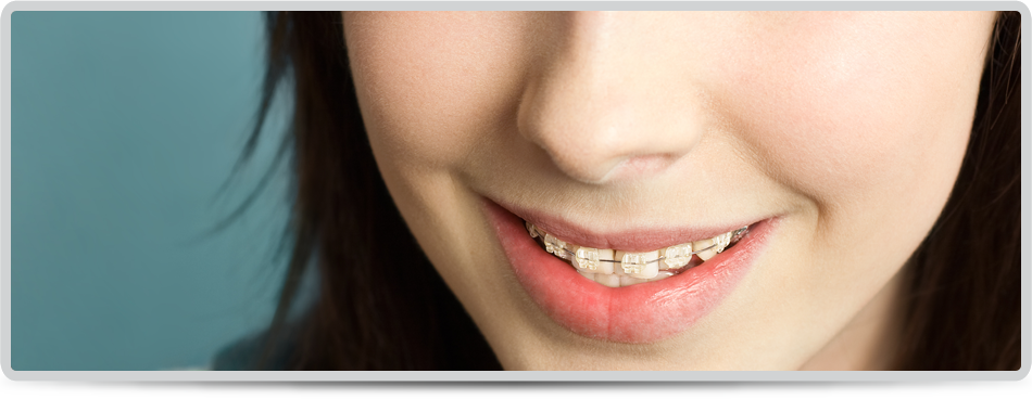 woman with tooth brace